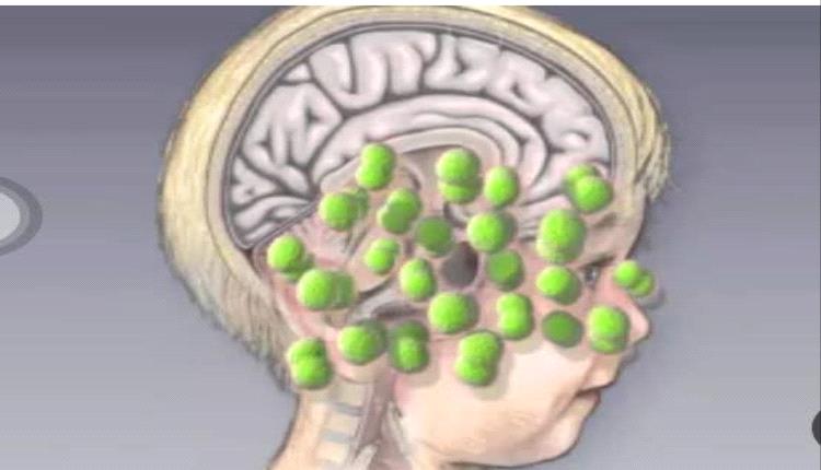 تسجيل 26 وفاة و1,232 إصابة بالتهاب السحايا في ثلاث محافظات