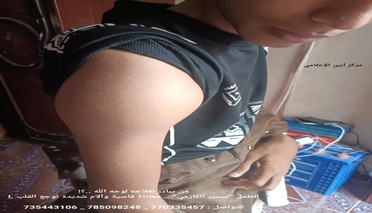 من يبادر لعلاجه لوجه الله ..؟.. الطفل ”تيسير الكازمي” .. معاناة قاسية وآلام شديدة توجع القلب .!