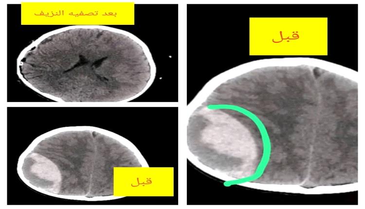 إنقاذ حياة طفل بعد نزيف خطير في الدماغ بعملية ناجحة في مستشفى الشهيد الدفيعة ببيحان