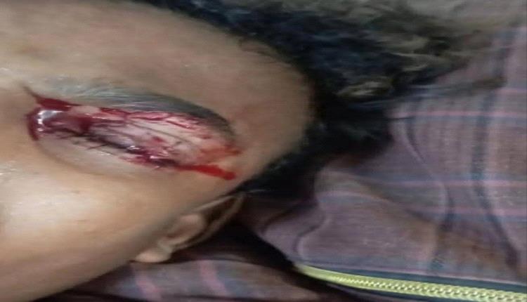 الطماش يتسبب بإصابة طفل في عينه وسط تحذيرات متصاعدة من مخاطره