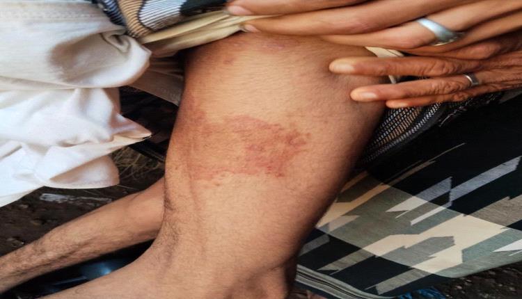 القوباء الحلقية تصيب عشرات المواطنين في الحديدة..والصحة توضح